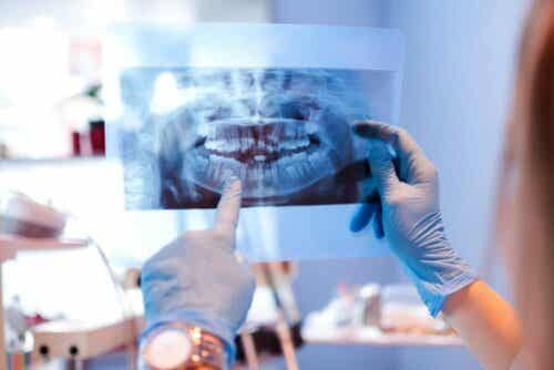 hammasimplantit ja niiden hoito