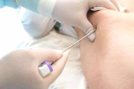 Luuydinaplasian diagnoosin saamiseksi on otettava luuydinnäyte.