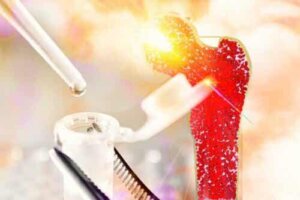 Mitä luuydinaplasia tarkoittaa?