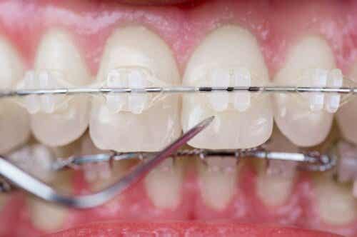 Ylipurenta voidaan hoitaa hammasraudoin.