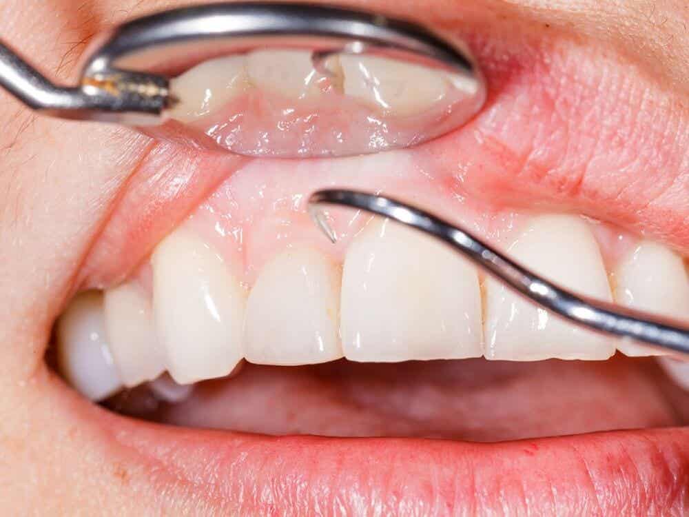 Plakkiväritabletit tekevät näkymättömästä hammasplakista näkyvän