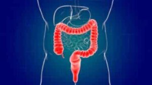 Proktiitti eli peräsuolen tulehdus