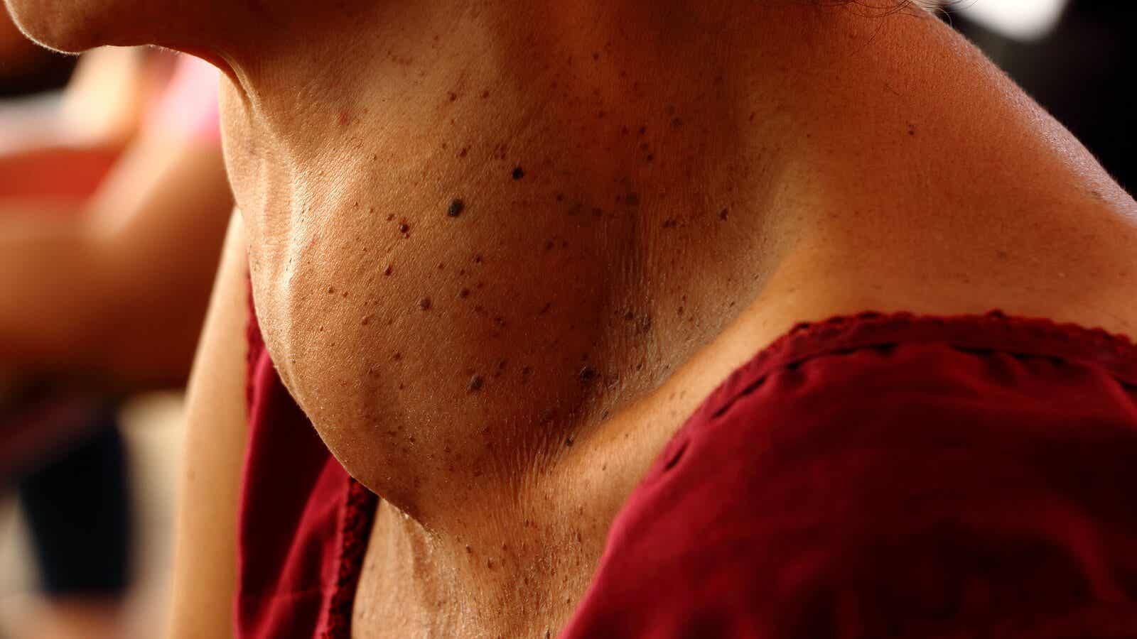 Struuma johtuu kilpirauhashormonien puutoksesta.