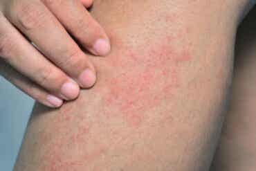 Järvisyyhy: syyt, oireet ja hoito