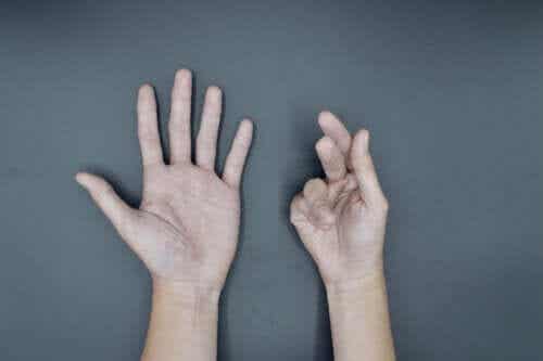 Dupuytrenin kontraktuura: aiheuttajat ja hoito