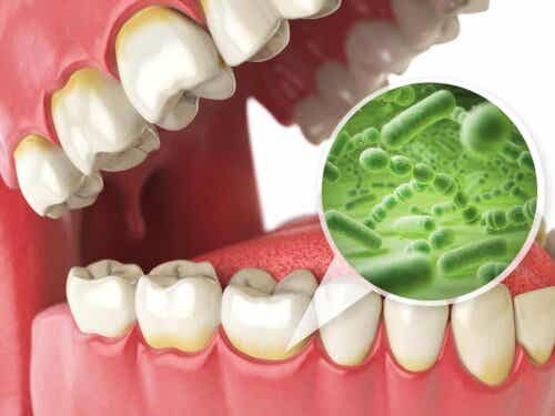 Peri-implantiitti voi syntyä suuhun kertyvien bakteerien seurauksena.
