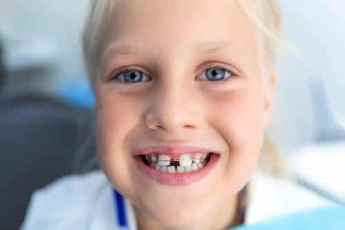 Rako hampaiden välissä on yleinen lasten ensimmäisessä hampaistossa.