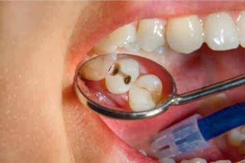 Yleisimmät hampaisiin liittyvät ongelmat lapsilla - hampaiden reikiintyminen.