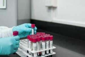 Nopea plasman reagiinitesti kupan diagnosointiin