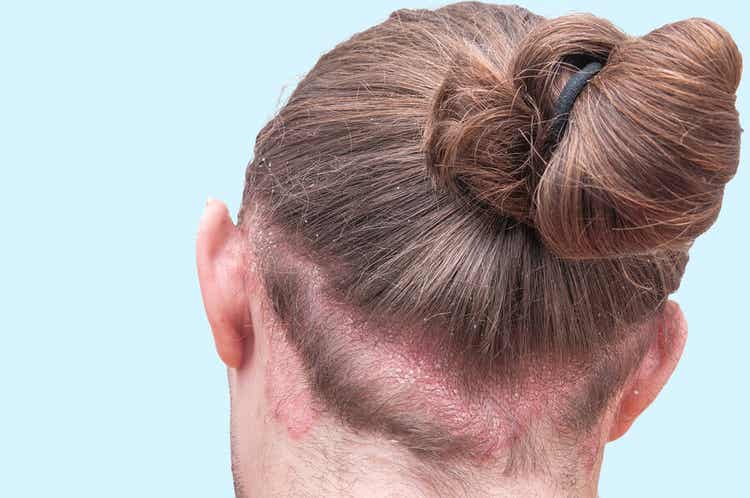 kulmakarvojen hilseily