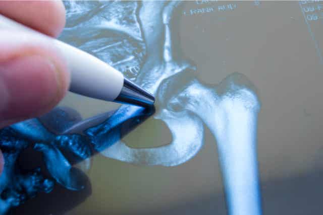 Röntgentutkimusta voidaan käyttää juveniilin idiopaattisen artriitin diagnosointiin.