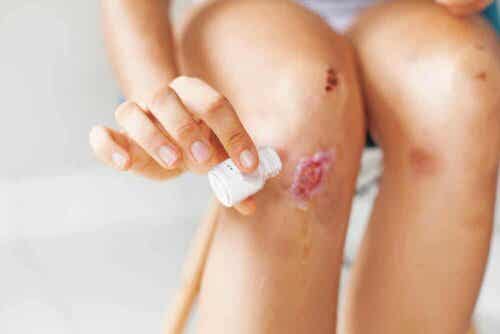 Angelica-juuri auttaa parantamaan haavoja.