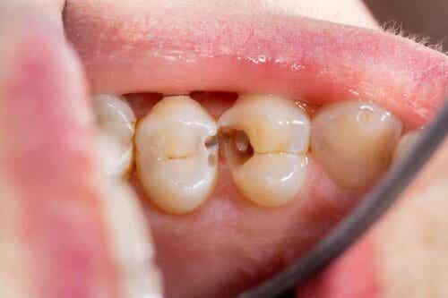 Fluori auttaa ehkäisemään hampaiden reikiä.