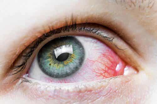 Silmäruohoja on käytetty jo satoja vuosia erityisesti silmävaivojen lievittämiseen.