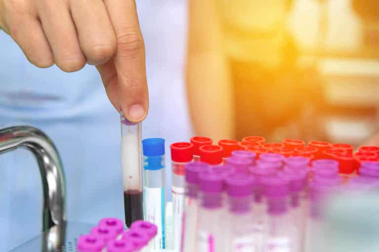 mikä on IgA-nefropatia