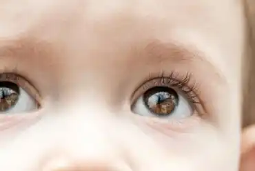 Lapsuuden glaukooma: mitä siitä tulisi tietää?
