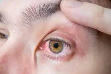 Silmän melanooma: oireet ja syyt