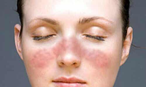 Autoimmuunisairauksilla on samankaltaisia oireita.