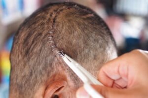 Mikä on kraniotomia ja milloin sitä tarvitaan?