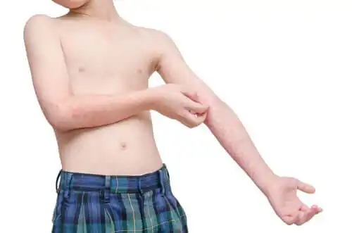 Atooppinen iho on yleisempi lapsilla.