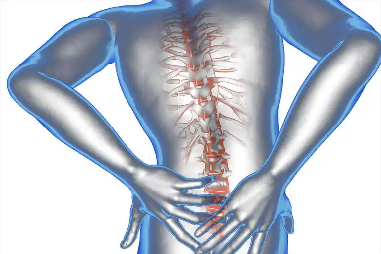 Cauda Equina -oireyhtymä on ongelma selkärangan alaosassa.