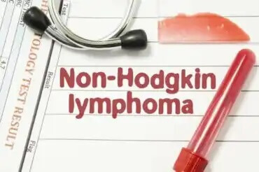 Non-Hodgkin-lymfooma: kaikki mitä tarvitsee tietää
