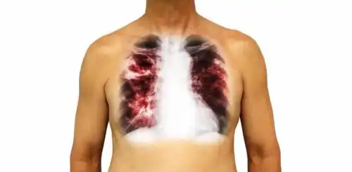 4 yleisintä tartuntatautia: tuberkuloosi.