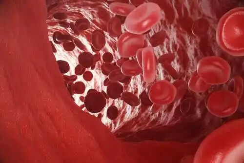 Anemia merkitsee liian vähäistä hemoglobiinin määrää punasoluissa.
