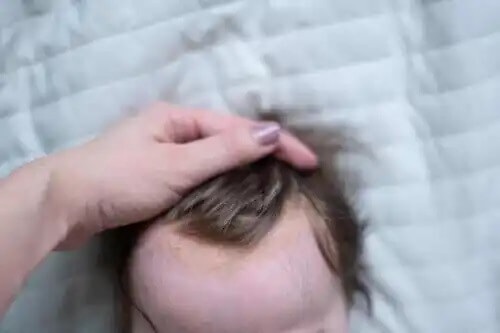 Lasten tali-ihottuma sijaitsee yleensä päänahassa.