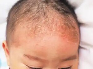 Mikä on lasten tali-ihottuma?