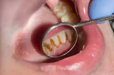Miksi hammaskivi muuttuu mustaksi? Hoito ja ehkäisy