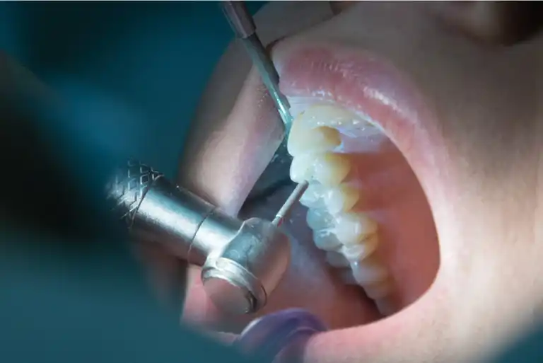 Hammaskipu hoidetaan hammaslääkärin vastaanotolla.