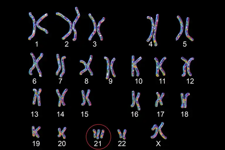 Edwardsin oireyhtymä: ylimääräinen kromosomi.