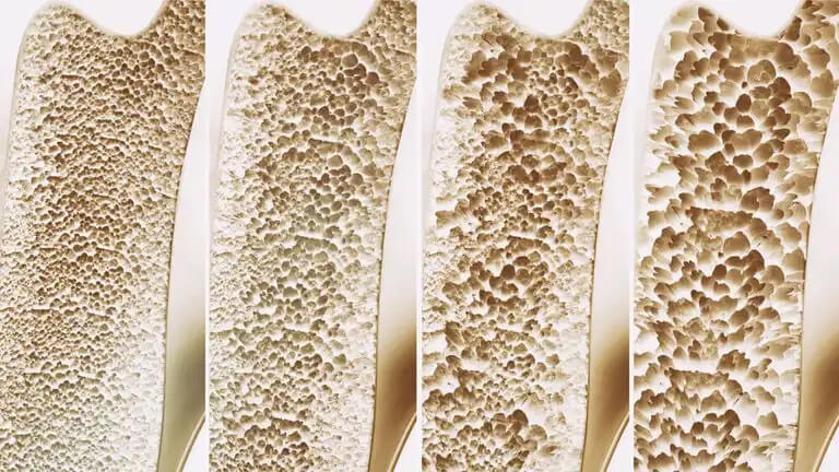 Osteoporoosi heikentää luita.