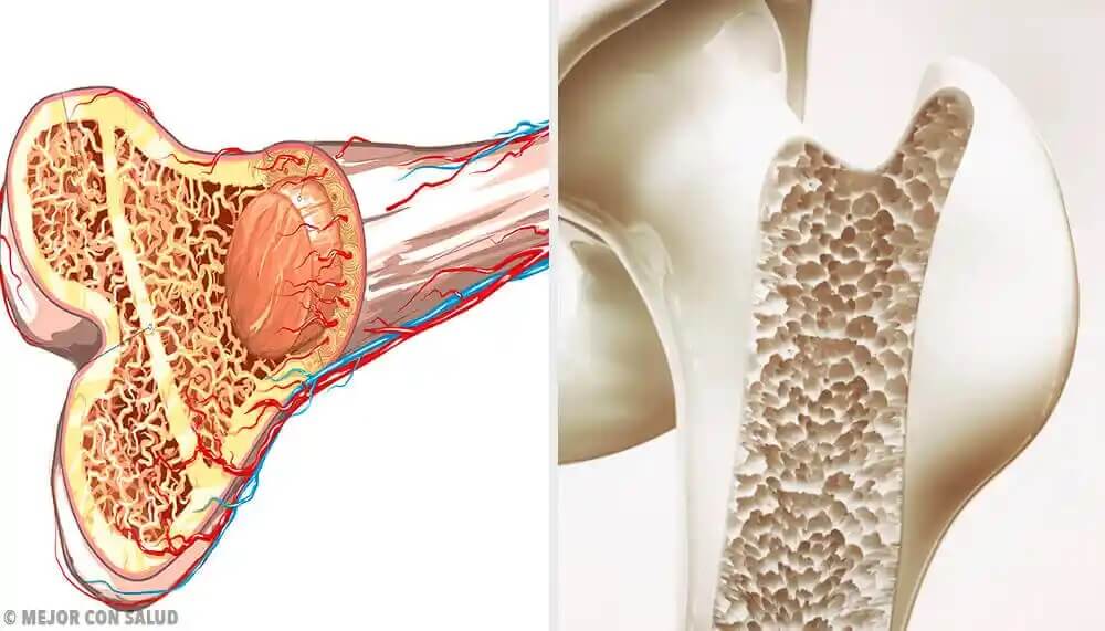 Ewingin sarkooma vaikuttaa luihin.