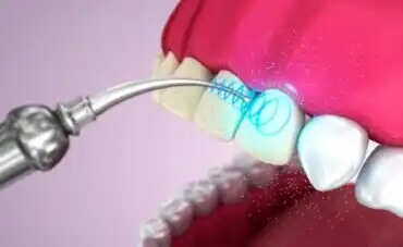Hampaiden ultraäänipuhdistus: hyödyt ja haitat