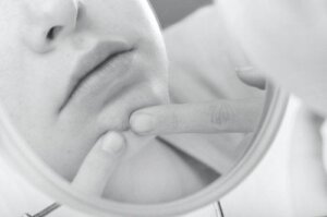 Kuinka päästä eroon ihonalaisista finneistä