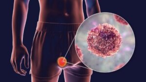 Teratooman tyypit, oireet ja hoidot