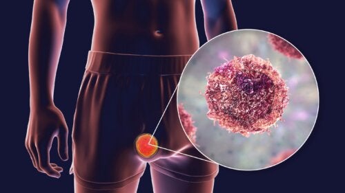 Teratooman tyypit, oireet ja hoidot