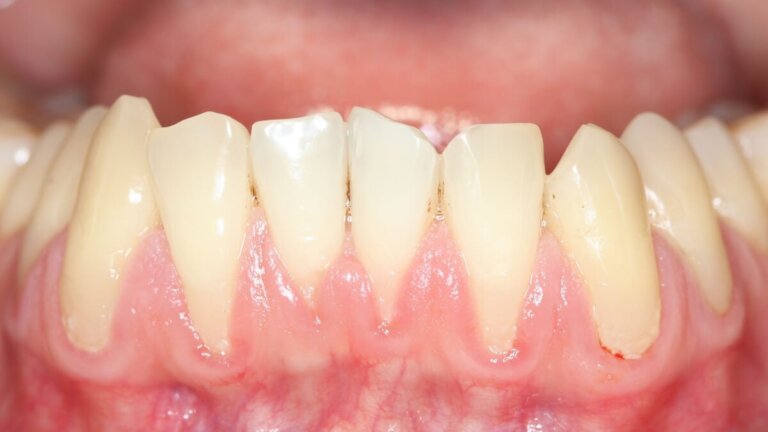 Mitä ikenien vetäytyminen on ja miksi sitä tapahtuu?